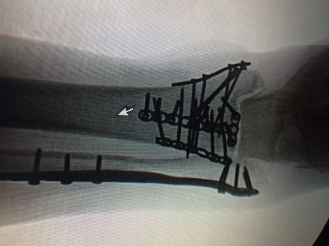 Patient image of: Larry Nipon