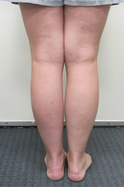 After photos of Bone transport and then nailing of the tibia