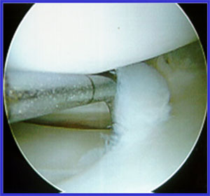 Arthroscopic photo showing meniscus surgery.