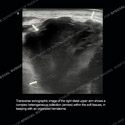 Ultrasound thumbnail image of case 189 - sonographic image of the right distal upper arm